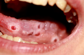 Bolestivé afty v ústach: Triky, ktoré zaberú v priebehu 24 hodín!