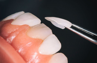 Čo sú zubné fazety a ako dokážu premeniť úsmev na dokonalosť?