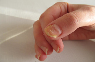 Žlté nechty na nohách i rukách signalizujú choroby nechtov: Kedy spozornieť?