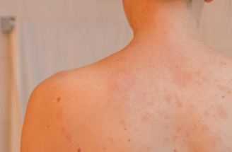 Čo je Heraldova škvrna (pityriasis rosea)? Kožné ochorenie sa môže objaviť u kohokoľvek!