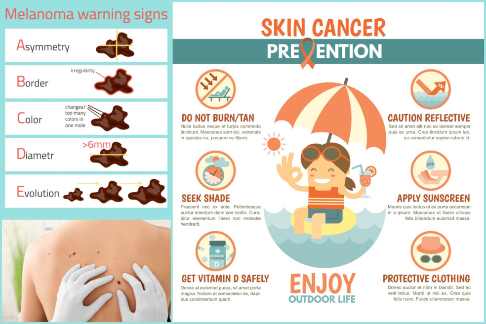 prejavy rakoviny kože