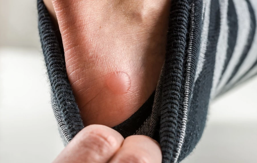 Ako ošetriť pľuzgier na nohe