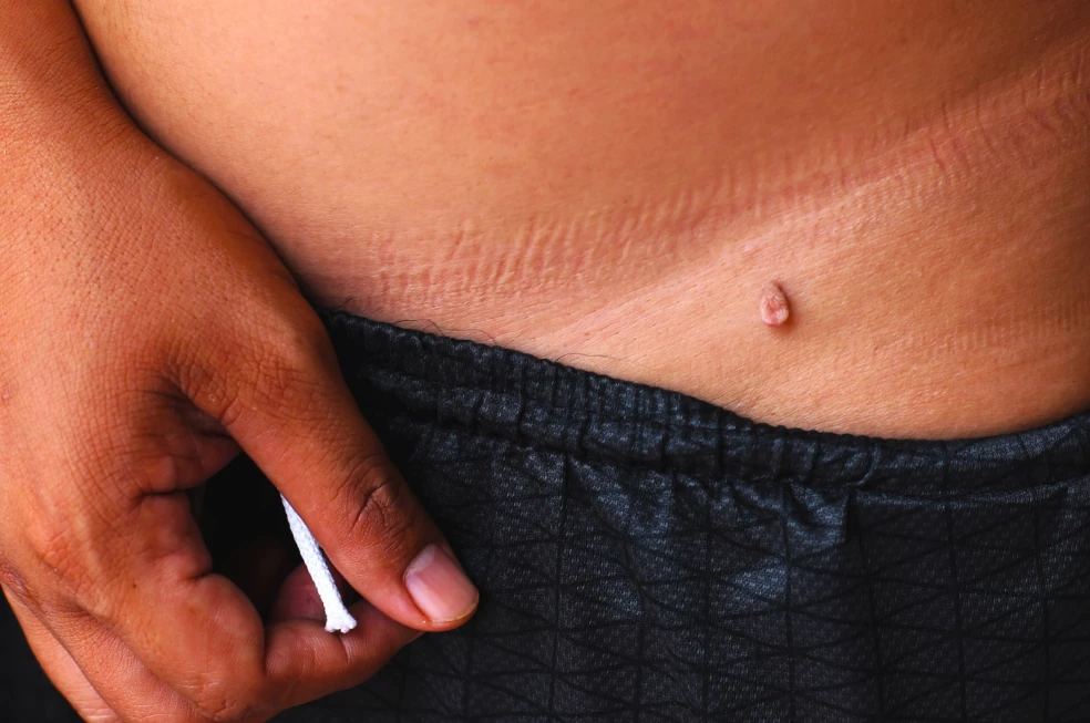 ako odstrániť kožné výrastky