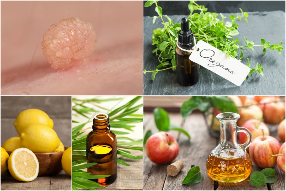 ako odstrániť kožné výrastky