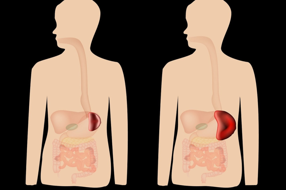 zväčšenie sleziny