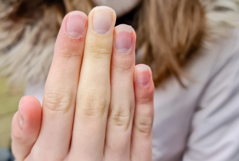 prejavy Raynaudovho syndrómu