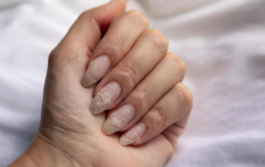 Varovné signály nechtov