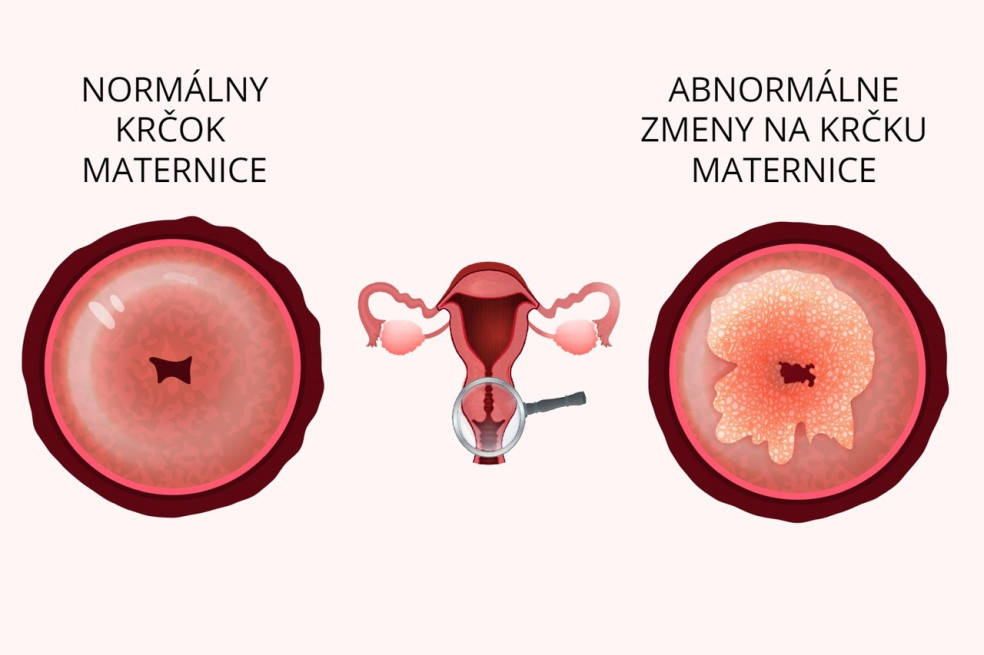 krčok maternice