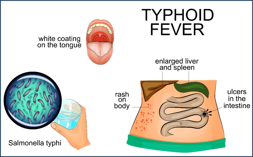 prejavy brušného týfusu