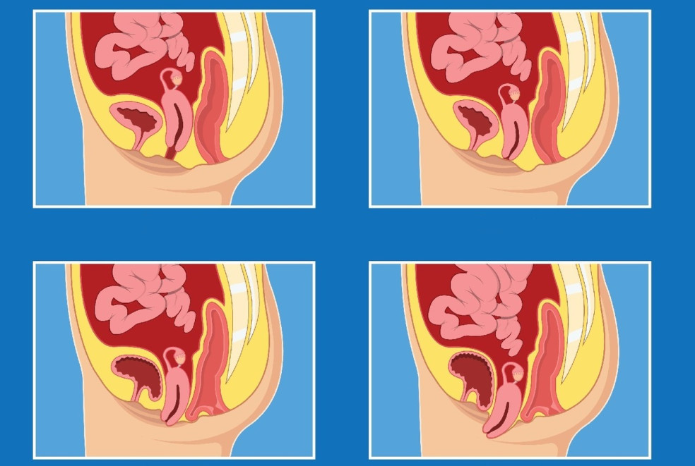 prejavy prolapsu maternice