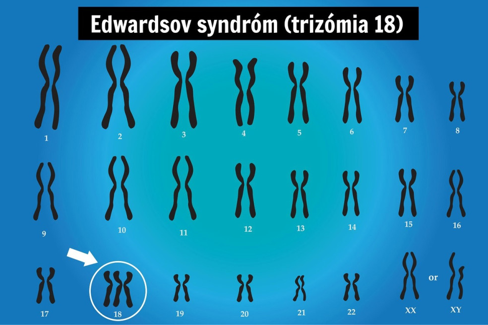 prejavy Edwardsovho syndrómu