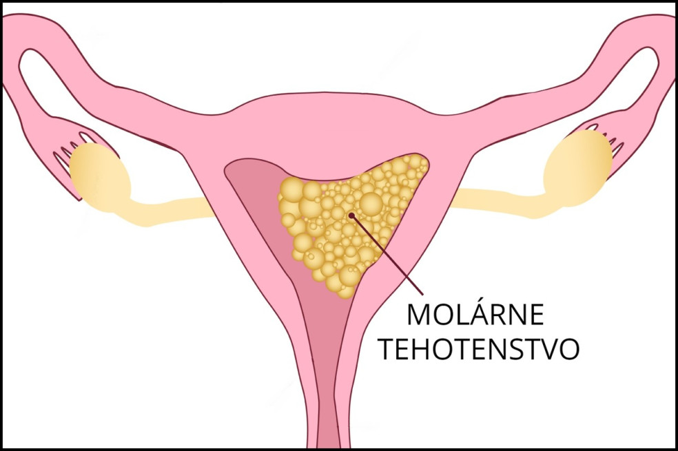 príznaky molárneho tehotenstva