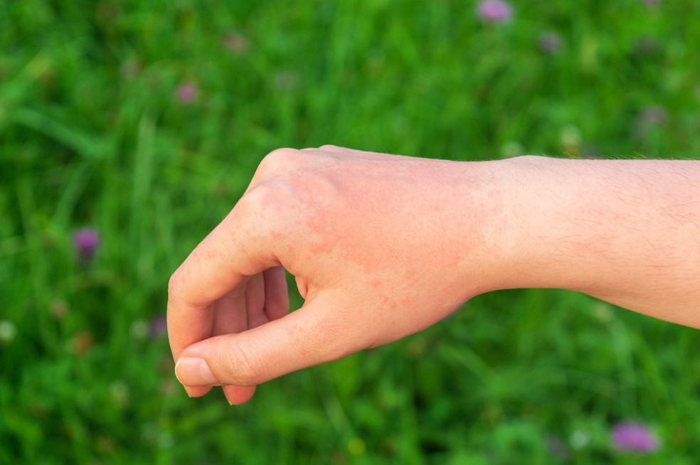 príznaky alergie na slnko