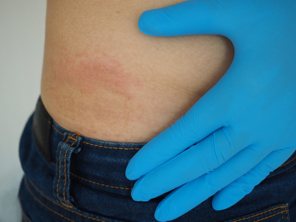 pityriasis rosea