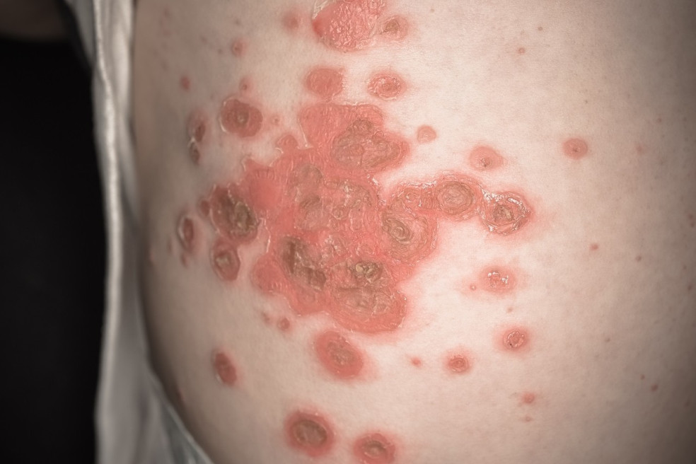 pityriasis rosea liečba