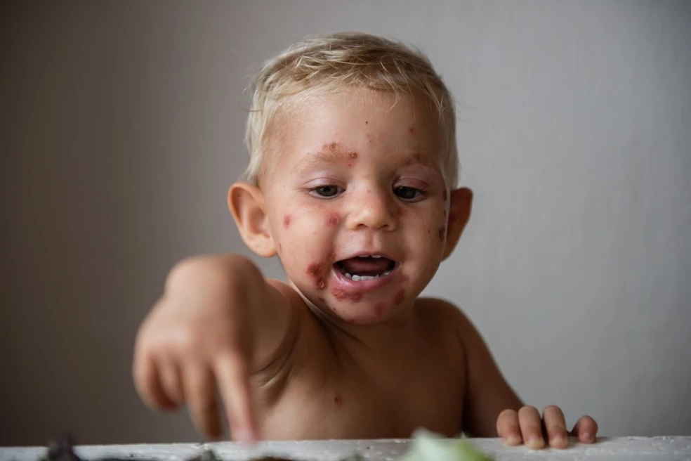 príznaky impetiga