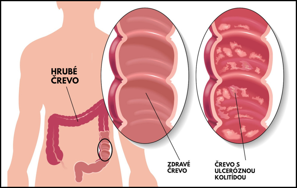 príznaky ulceróznej kolitídy