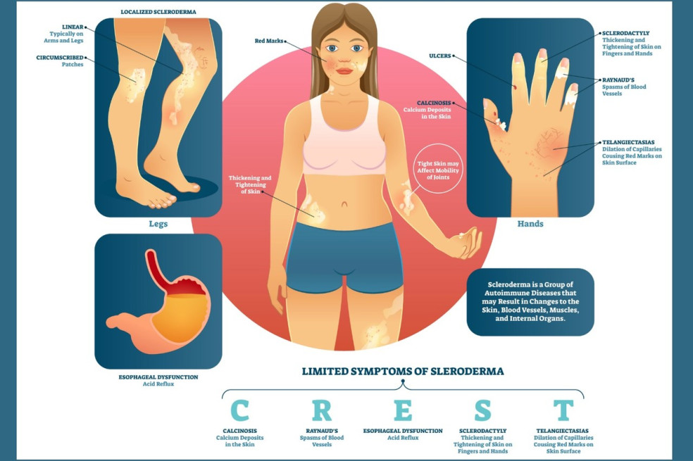 prejavy sklerodermie