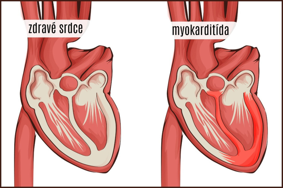 príznaky myokarditídy