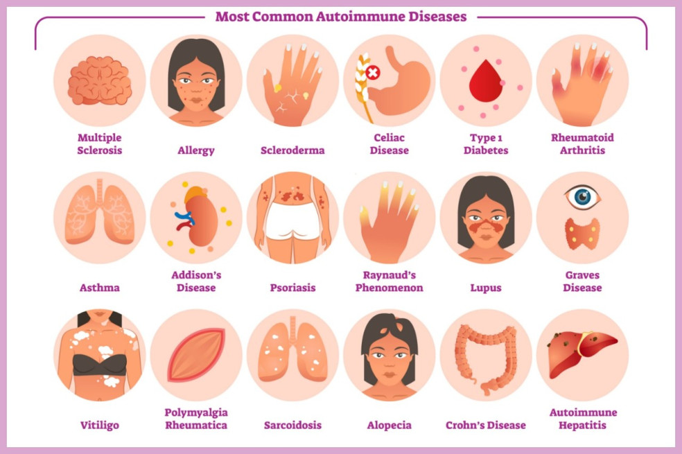 najčastejšie autoimunitné ochorenia