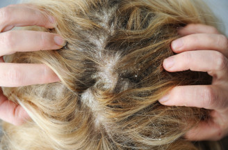 Ochorenia vlasovej pokožky: Takto si s nimi hravo poradíš!
