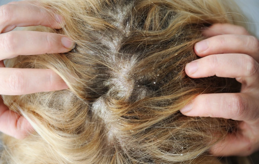 Ochorenia vlasovej pokožky