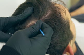Mikropigmentácia pokožky hlavy: Dokáže zvrátiť vypadávanie vlasov a ich rednutie?!