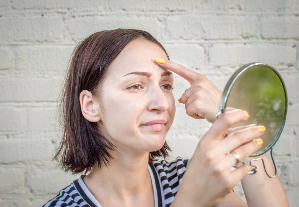 domáca liečba akné