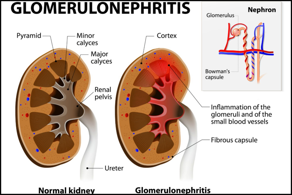 príznaky glomerulonefritídy