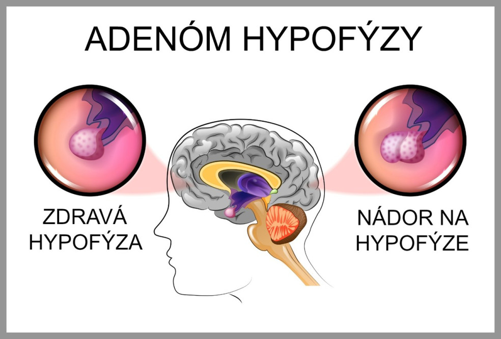 nádor na hypofýze