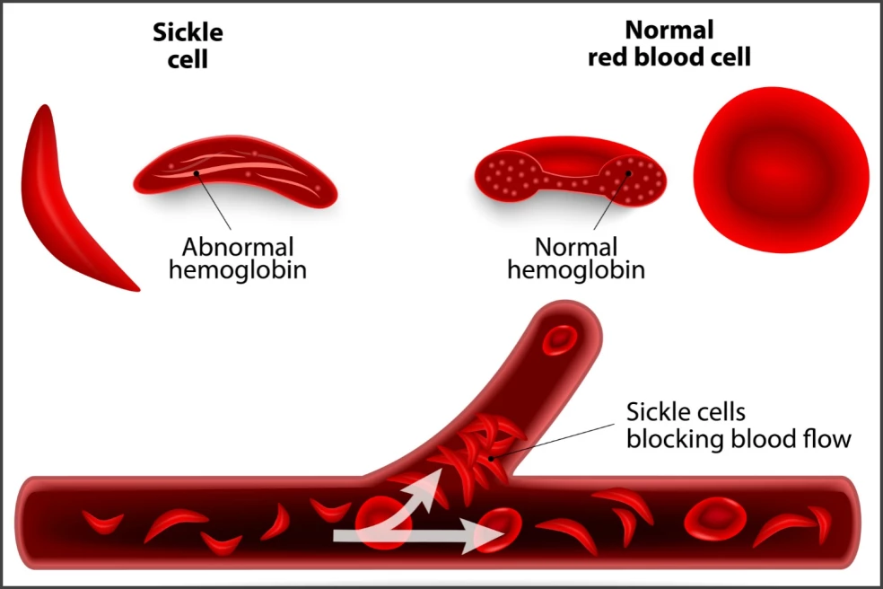 prejavy kosáčikovej anémie