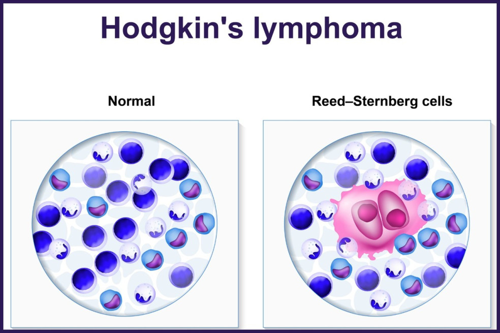 prejavy Hodgkinovho lymfómu