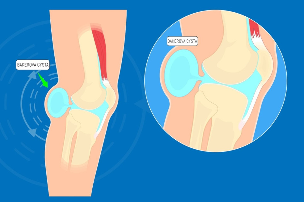Bakerova cysta