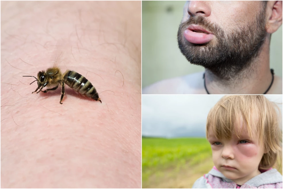 alergická reakcia po bodnutí hmyzom