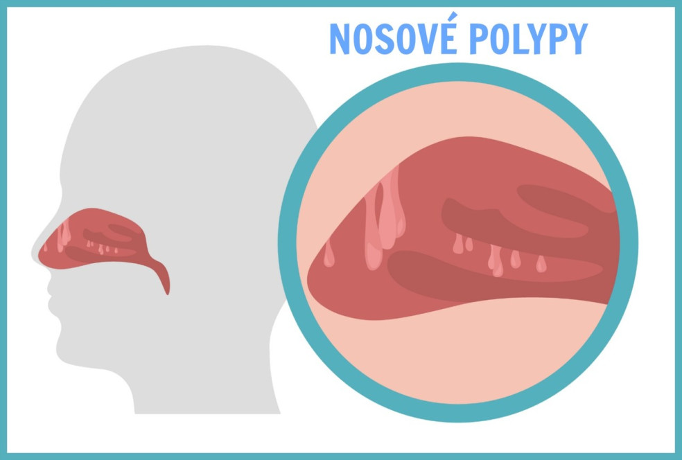 nosové polypy