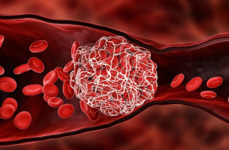 Trombofília – u koho sa vyskytuje a čo to pre človeka znamená?