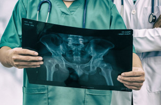 Zvýšená lámavosť kostí: Príčinou môže byť vážne genetické ochorenie