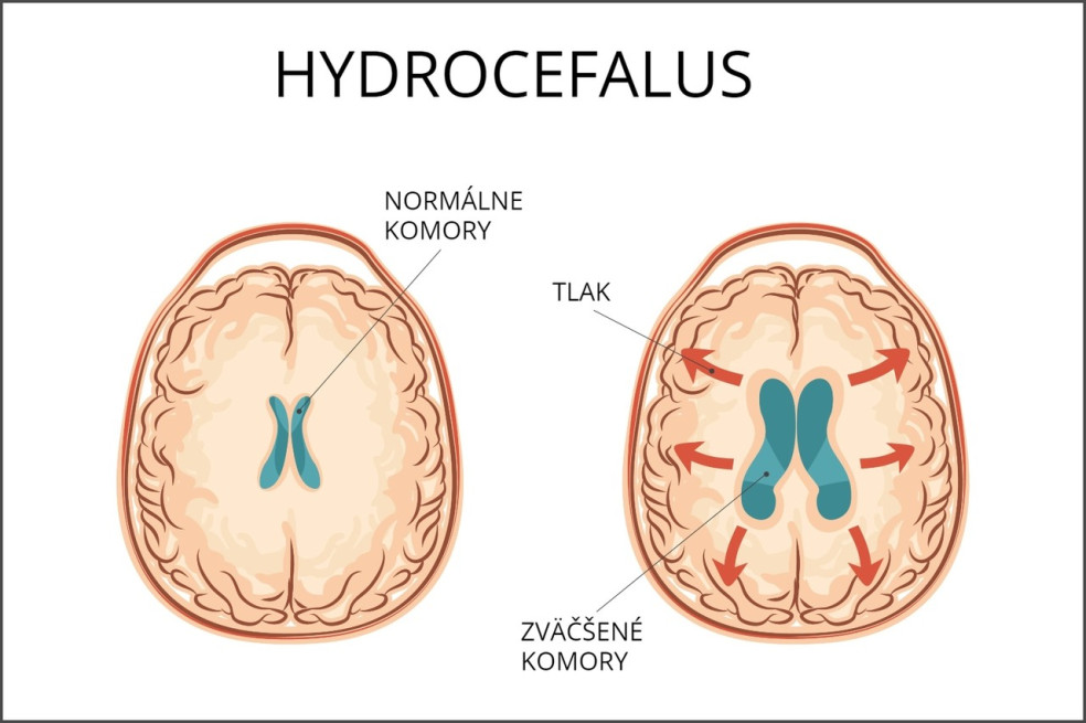 príznaky hydrocefalu