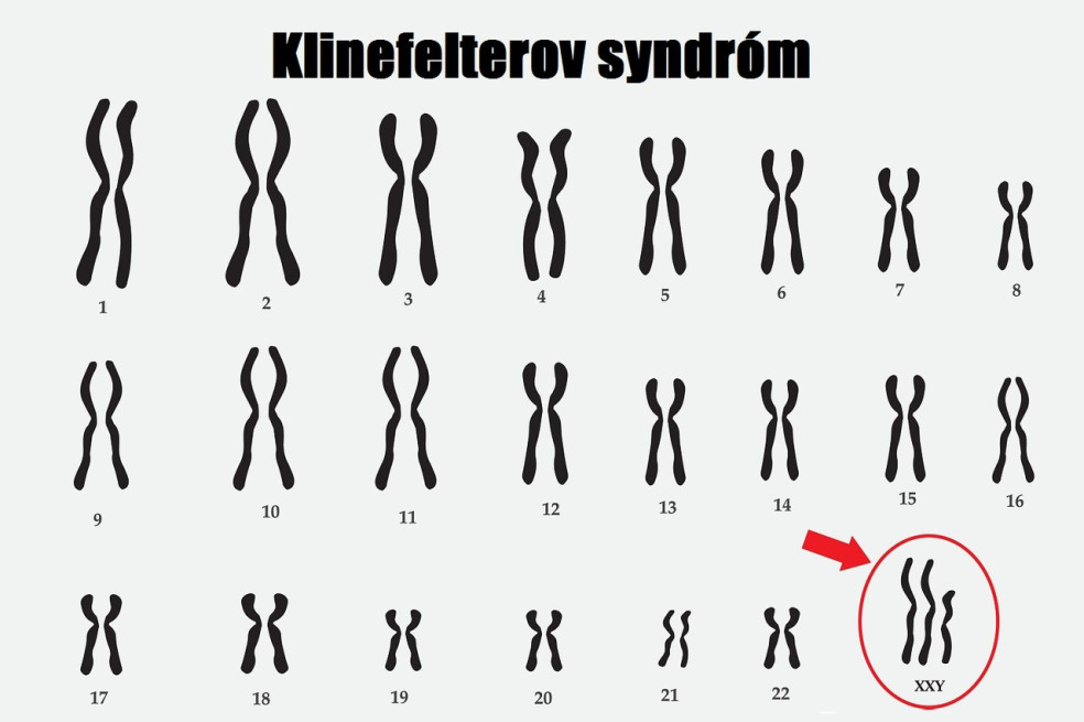 príznaky Klinefelterovho syndrómu