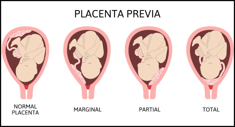 nesprávne uloženie placenty