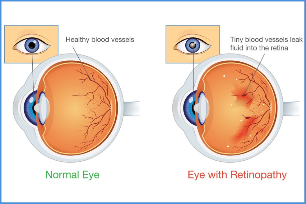 príznaky retinopatie