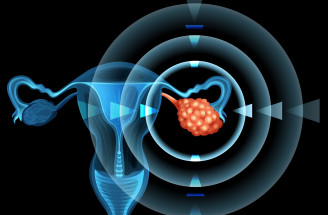 Zákerná rakovina vaječníkov: Dá sa rozpoznať včas? A čo liečba?