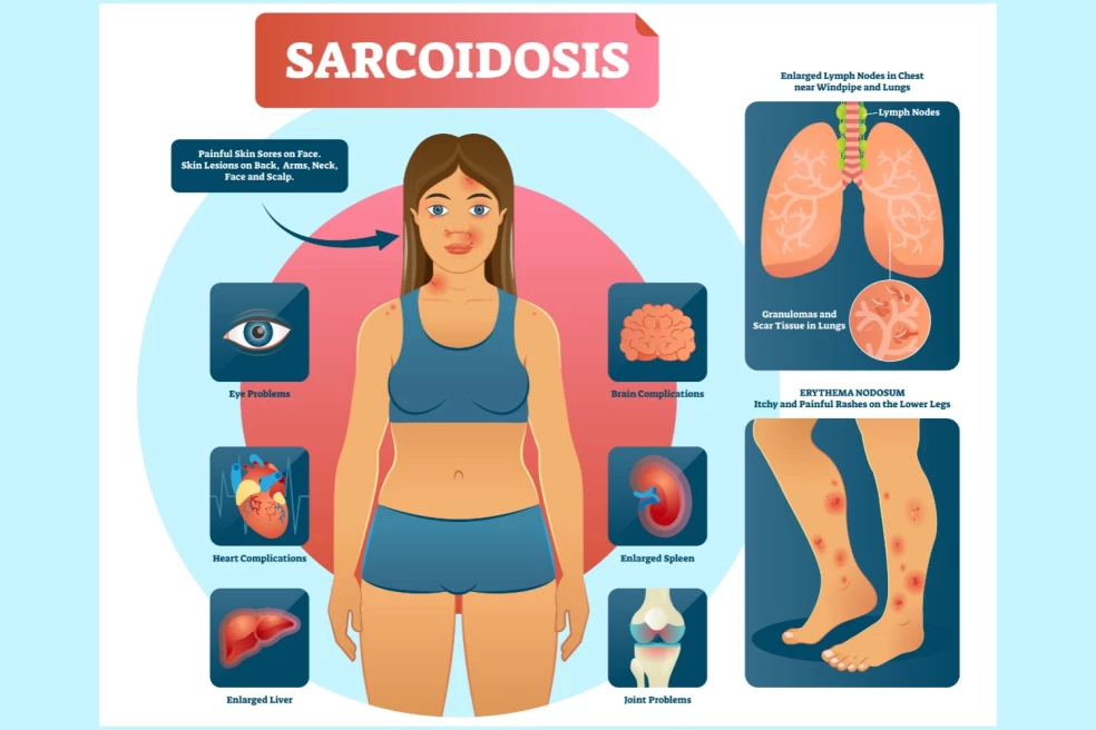 prejavy sarkoidózy