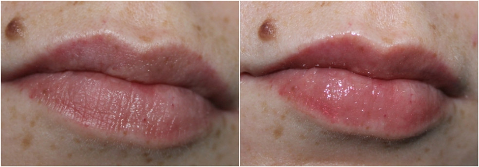 pharma hyaluron - volume lip booster