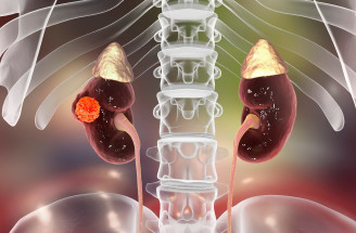 Rakovina obličiek – zákerná, no liečiteľná. Ako ju včas odhaliť?