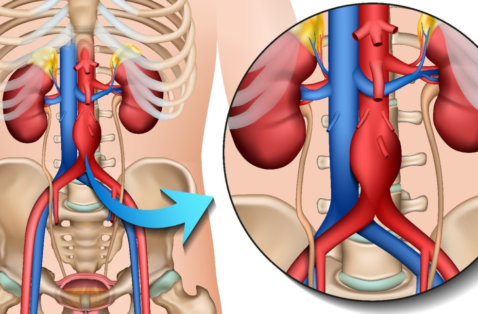aneuryzma brušnej aorty