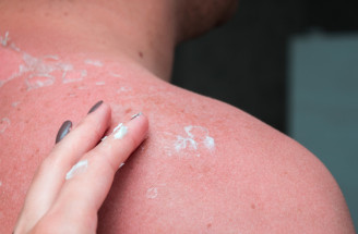 TOP kozmetika po opaľovaní: Je vôbec nutné pleť po slnení ošetriť?