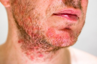 Seboroická dermatitída: Čo môže spustiť rozvoj ochorenia?