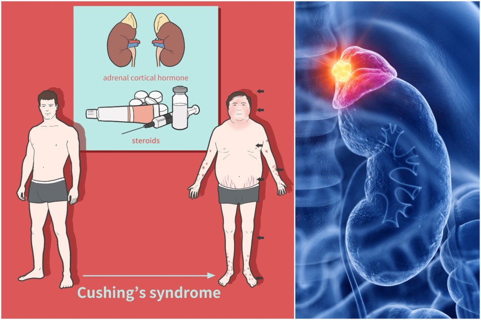 prejavy Cushingovho syndrómu