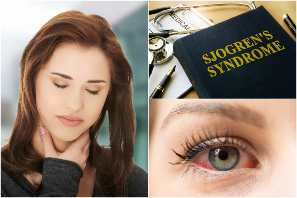 prejavy Sjögrenovho syndrómu
